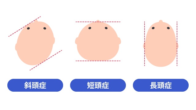 斜頭症について説明する図です