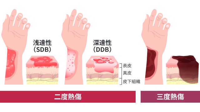 二度熱傷と火傷の3度との違いについて説明する図です
