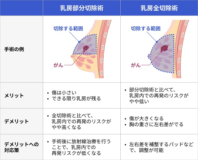 乳がんの部分切除と全摘出のメリットとデメリットを説明する図です