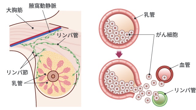 脈管侵襲を説明する図です