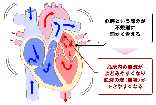 心房細動について説明した図