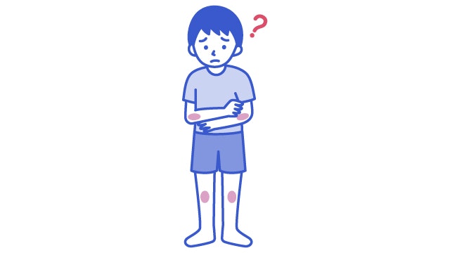 血友病で覚えのないあざを説明する図です