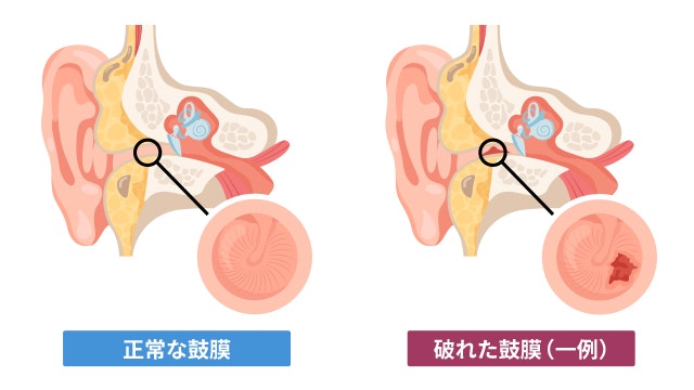 正常な鼓膜と破れた鼓膜の比較図です