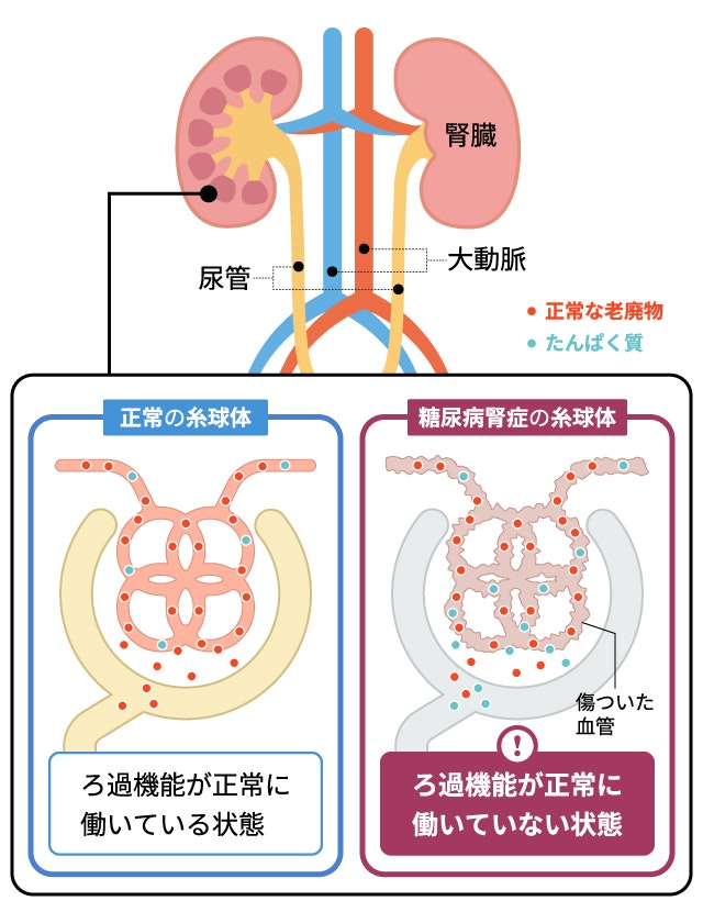 糖尿病腎症の状態について説明する図です
