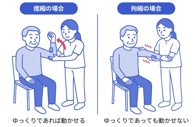 痙縮と拘縮の違いを説明する図です