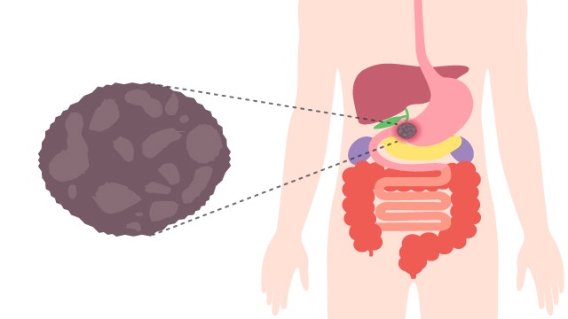 柿胃石を説明する図です