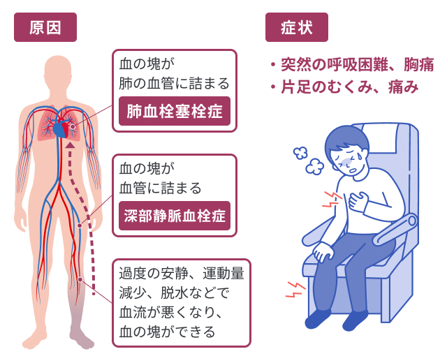 肺血栓塞栓症の症状がわかる写真や画像はありますか？ ｜肺血栓塞栓症