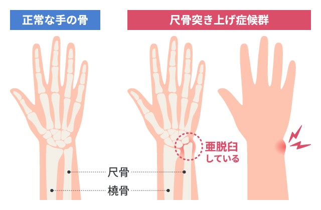 尺骨突き上げ症候群見た目の変化について説明する図です