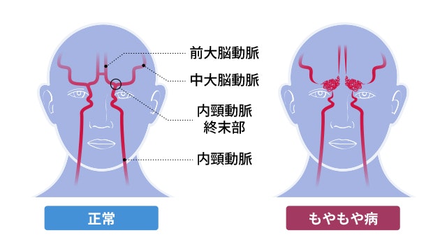 もやもや病のイラスト