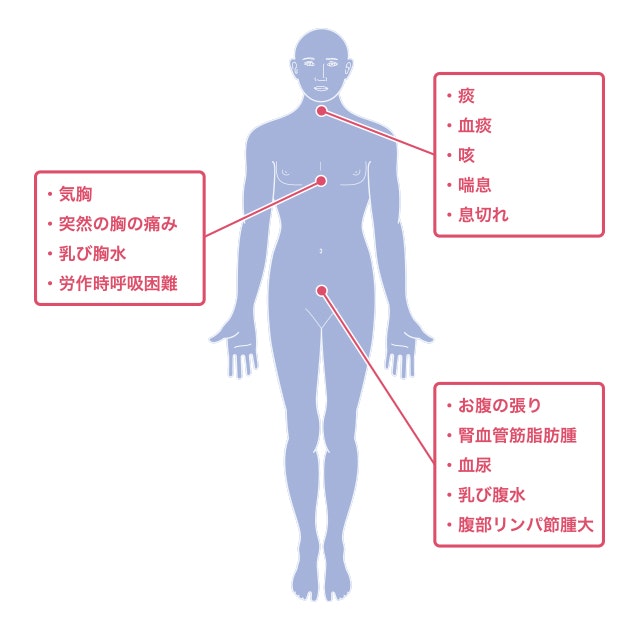 リンパ脈管筋腫症の症状を説明した図です。
