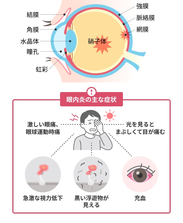 眼内炎を説明する図です