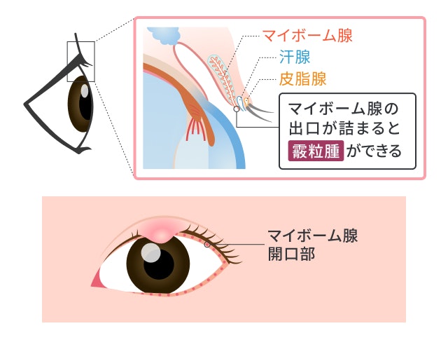 霰粒腫を説明する図です