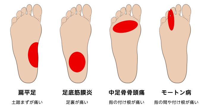 足の裏の痛む場所による病気の違いを図示しています