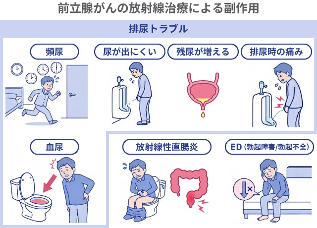 前立腺がんの放射線治療による副作用をまとめたイラスト。頻尿、排尿困難、血尿、放射線性直腸炎、EDなどの症状を説明しています。