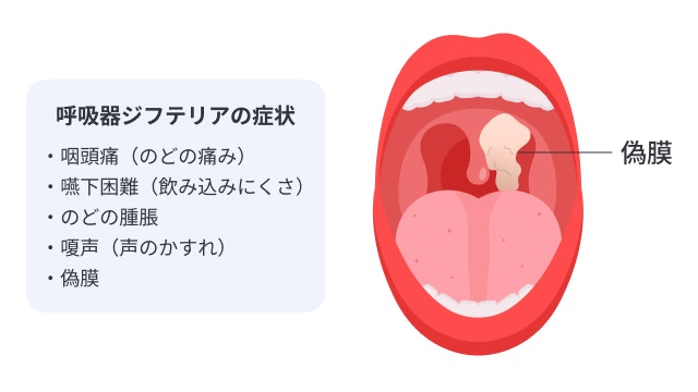 呼吸器ジフテリアの症状を説明する図です