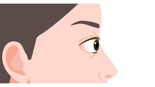 眼球突出の横顔の見え方を説明する図です