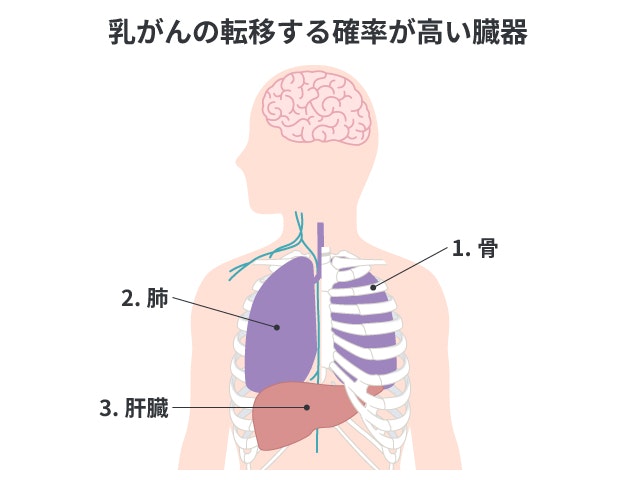 乳がんの遠隔転移を説明する図です