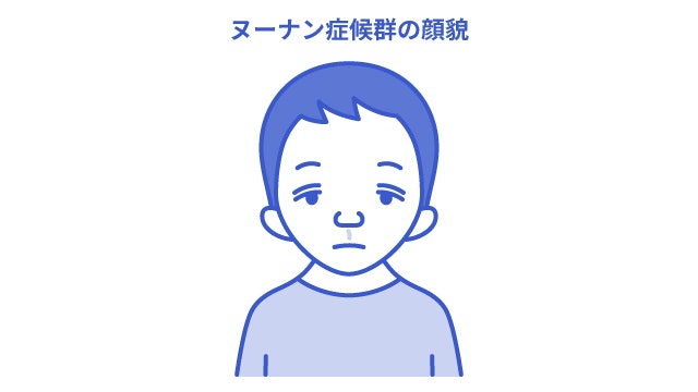 ヌーナン症候群の人の顔つきの特徴を説明する図です