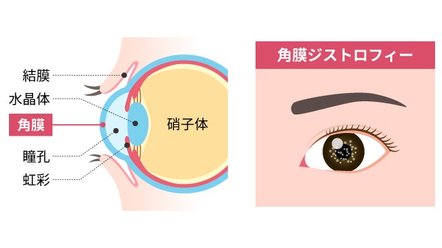 角膜ジストロフィーを説明する図です