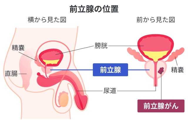 前立腺がんの説明として、前立腺と周辺の臓器の位置関係を、横から見た図と正面から見た図で解説しています。