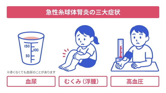 急性糸球体腎炎の三大症状を説明する図です