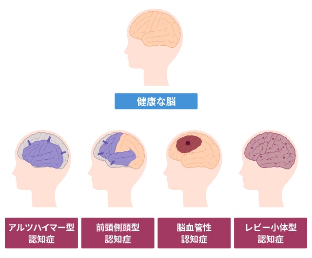 健康な脳と各型の認知症の脳を比較する図です