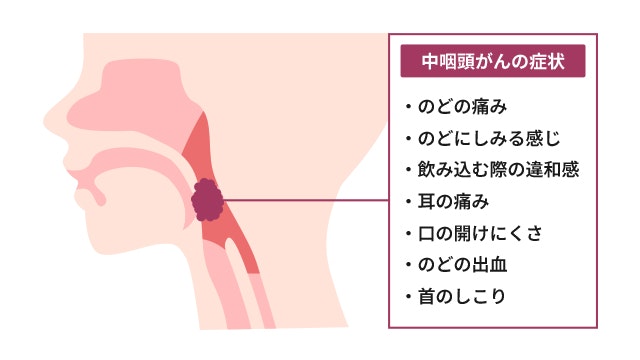 中咽頭がんのイラスト