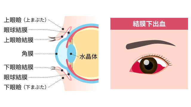結膜下出血を説明する図です