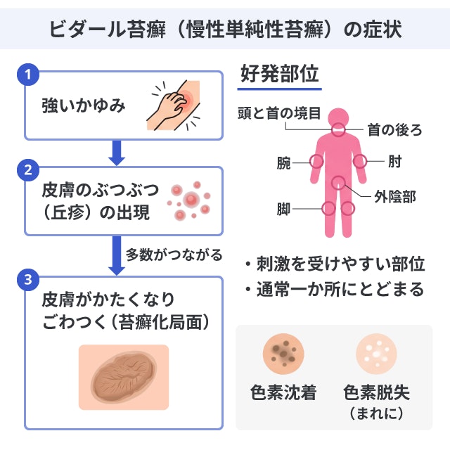 ビダール苔癬（慢性単純性苔癬）の症状を解説したイラストです。強いかゆみから丘疹を経て皮膚が硬くごわつく状態へと進行する過程と、好発部位マップ、色素沈着とまれに色素脱失があることを説明しています。
