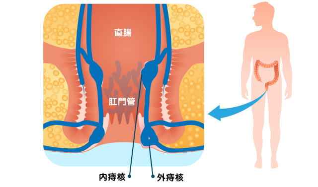 外痔核と内痔核の場所の違いを説明した図です