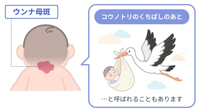 ウンナ母斑(赤ちゃんのうなじにできる赤いあざ)が「コウノトリのくちばしのあと」と呼ばれる由来を、コウノトリが赤ちゃんを運ぶイラストと共に解説しています。