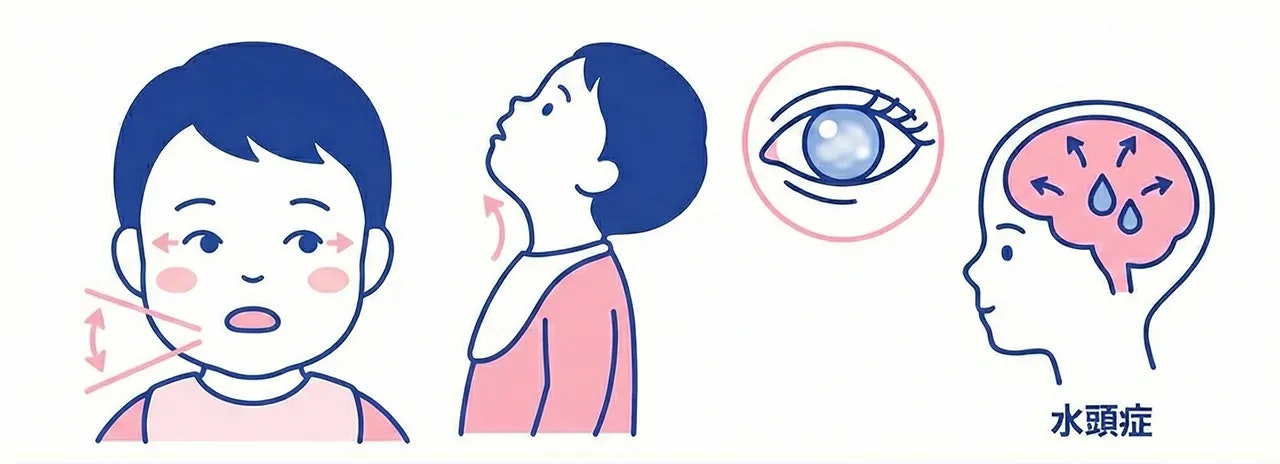 ゴーシェ病の神経型（II型・III型）で現れる頭部・顔面の症状を説明するイラスト。眼球運動障害、口が開きにくい（開口障害）、首が後ろにそり返る（頸部後屈）、および脳脊髄液が溜まる合併症として水頭症で頭が大きくなる。