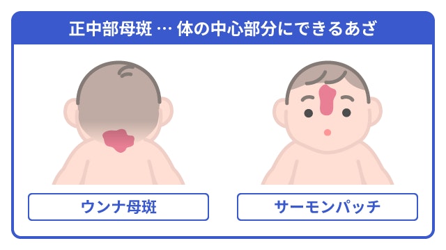 ウンナ母斑とサーモンパッチの発生部位の違いを比較したイラスト。体の中心にできる正中部母斑として、赤ちゃんのうなじにあるウンナ母斑と、額から鼻筋にあるサーモンパッチの位置を分かりやすく示しています。
