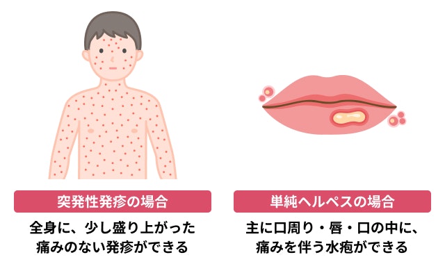 突発性発疹とヘルペスの違いを説明する図です