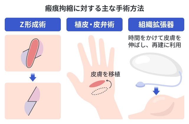 瘢痕拘縮に対する主な手術方法の図解。左は「Z形成術」で傷をジグザグに縫う方法。中央は「植皮・皮弁術」で皮膚を移植する方法。右は「組織拡張器」を埋め込み、時間をかけて皮膚を伸ばし再建に利用する方法。