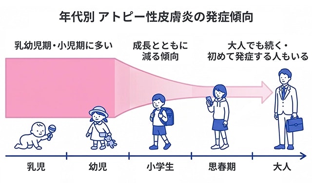アトピー性皮膚炎の年代別発症傾向を示す概要図。乳幼児期に最も多く、成長とともに減少するものの、大人でも継続や初発するケースがあることを、年齢ごとの人物イラストと矢印の太さの変化で表現しています。
