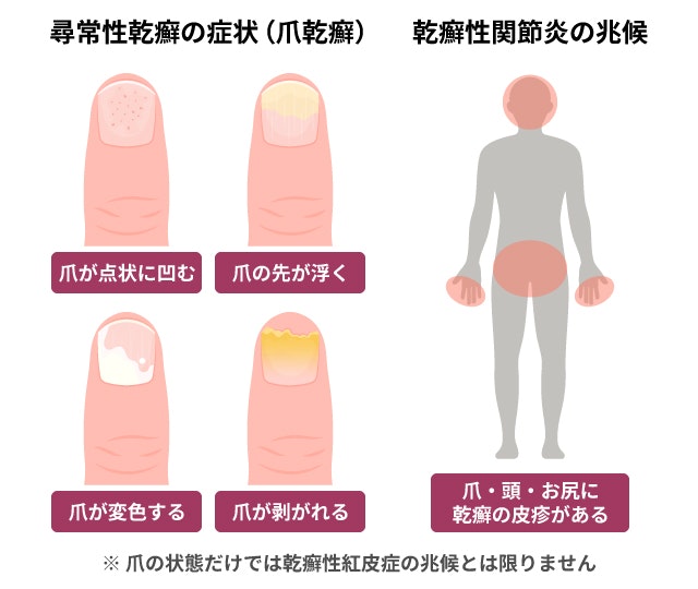 乾癬性紅皮症の兆候を説明する図です