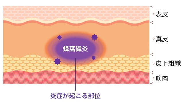 蜂窩織炎はどのように治療されますか?