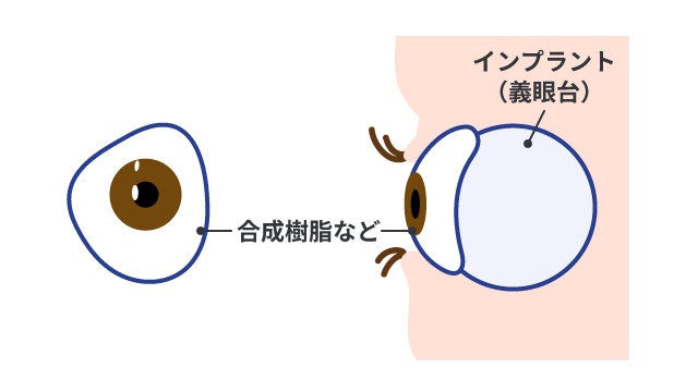 義眼を説明する図です