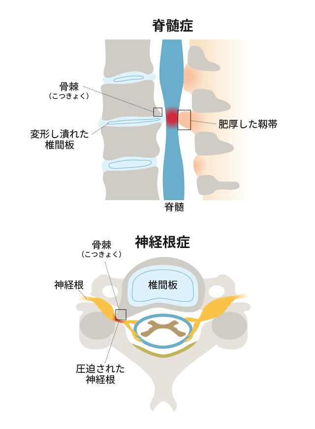 頚椎症の原因は何がありますか？ ｜頚椎症