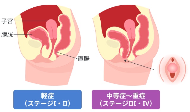 膀胱瘤の軽症（ステージⅠ・Ⅱ）と中等症〜重症（ステージⅢ・Ⅳ）の比較図。膀胱が軽症では体内にとどまっているが、重症になると膣口から飛び出し、見た目にもわかる様子をイラストで解説しています。