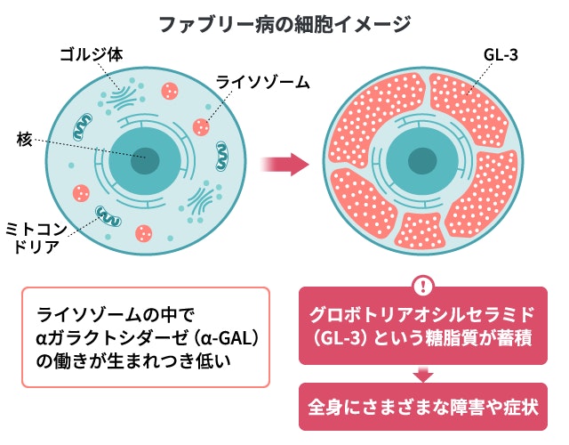 ファブリー病の発症メカニズム図解。細胞内のライソゾームにある酵素「αガラクトシダーゼ（α-GAL）」の働きが生まれつき低いため、分解されるはずの糖脂質「グロボトリアオシルセラミド（GL-3）」が蓄積していく様子を比較。ゴルジ体、核、ミトコンドリアがある正常な細胞に対し、GL-3が蓄積して全身に障害を引き起こす細胞の変化を示したイラスト。