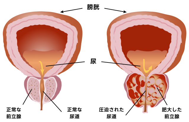 正常な前立腺と前立腺肥大症が起こった前立腺との比較と、前立腺とその周辺の臓器について表した図