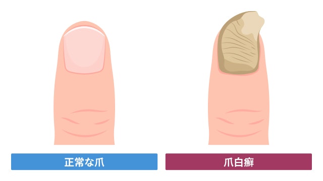 通常の爪と爪白癬の爪との比較図です