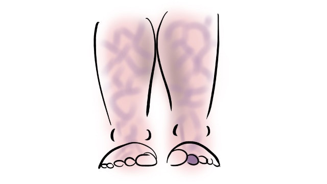 網状皮斑について説明する図です