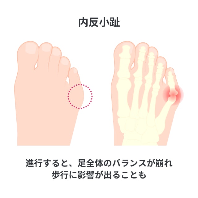 内反小趾という病気について、足の小指の骨が内側に曲がって関節が外側に突き出た状態を骨格のイラストで解説しています。進行すると足全体のバランスが崩れ歩行に影響が出る注意点も書いています。