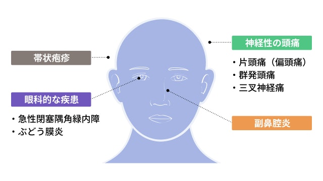 目の上の痛みを説明する図です
