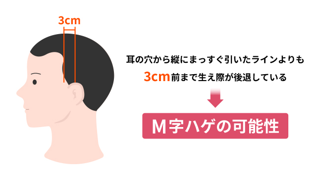 M字はげの基準・見分け方を教えてください。 ｜AGA（男性型脱毛症）