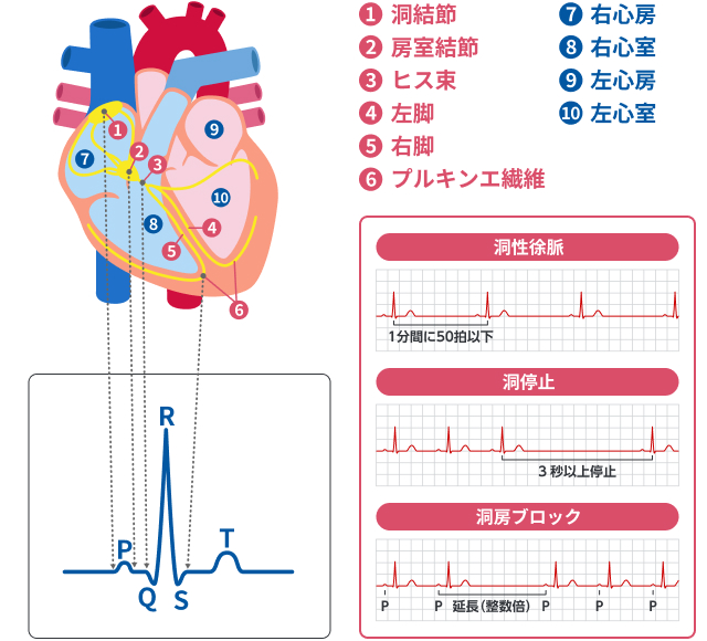 洞不全症候群の心電図の特徴を教えてください。 ｜洞不全症候群