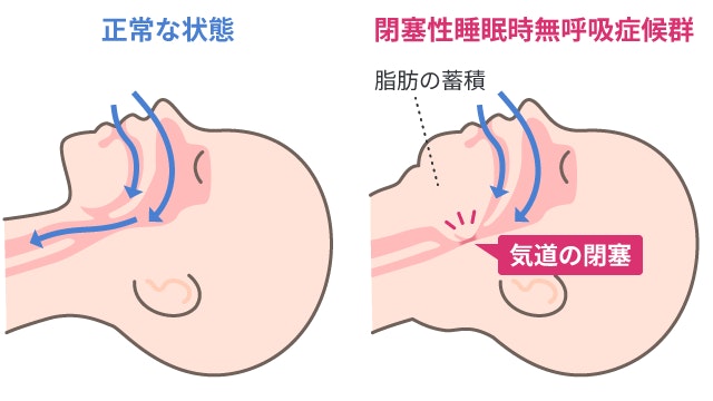 肥満症による首周りの脂肪の蓄積が気道を圧迫・閉塞させ、閉塞性睡眠時無呼吸症候群を引き起こすメカニズムを、正常な状態と解剖イラストで比較しています。